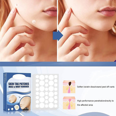 Fast Skin Tag Removal Patch 144 Patches